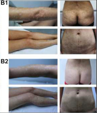 患者二治療前后對比圖