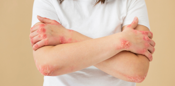 干細(xì)胞治療系統(tǒng)性紅斑狼瘡：如何實(shí)現(xiàn)從短期的疾病癥狀緩解到長(zhǎng)期的多器官功能改善？