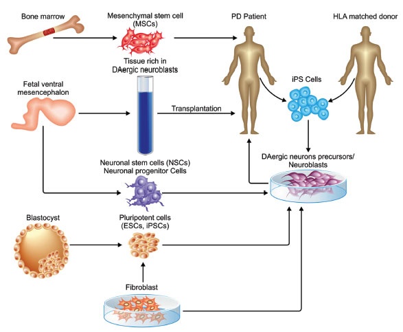 圖 (1)。不同類型的干細(xì)胞可用于帕金森病的修復(fù)。