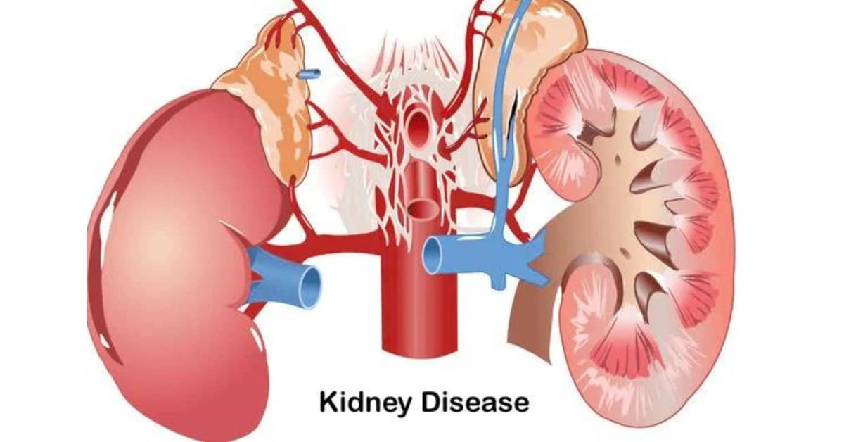 干細胞治療腎?。红o脈、動脈、皮質注射哪種更安全