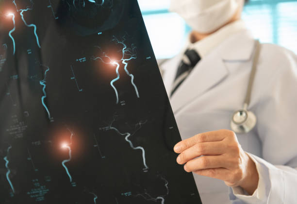 骨髓干細胞治療缺血性卒中靠譜嗎？網絡薈萃分析給出答案