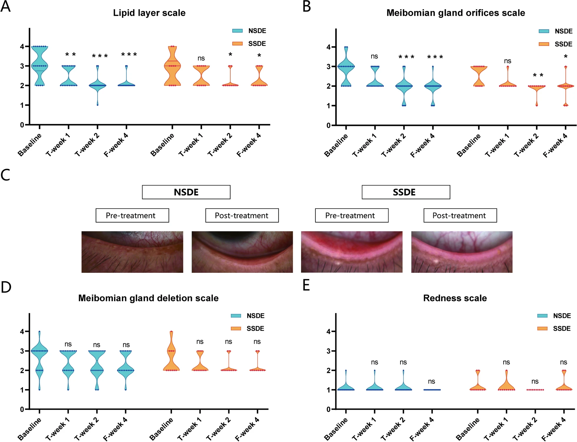 圖3：NSDE和SSDE組基線、T第1周、T第2周和F第4周的脂質層、瞼板腺和紅斑量表。