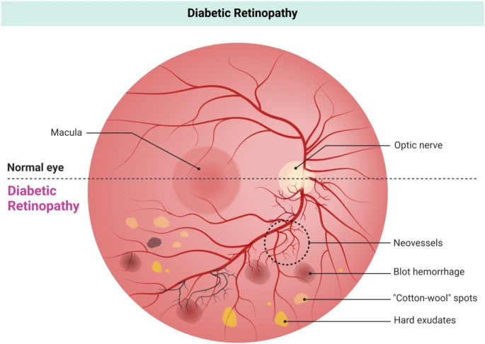 圖7:糖尿病視網(wǎng)膜病變圖示,顯示視網(wǎng)膜異常,例如新生血管、點(diǎn)狀出血、棉絨斑和硬性滲出物。對(duì)比圖突顯了正常視網(wǎng)膜與糖尿病引起的血管并發(fā)癥之間的差異。