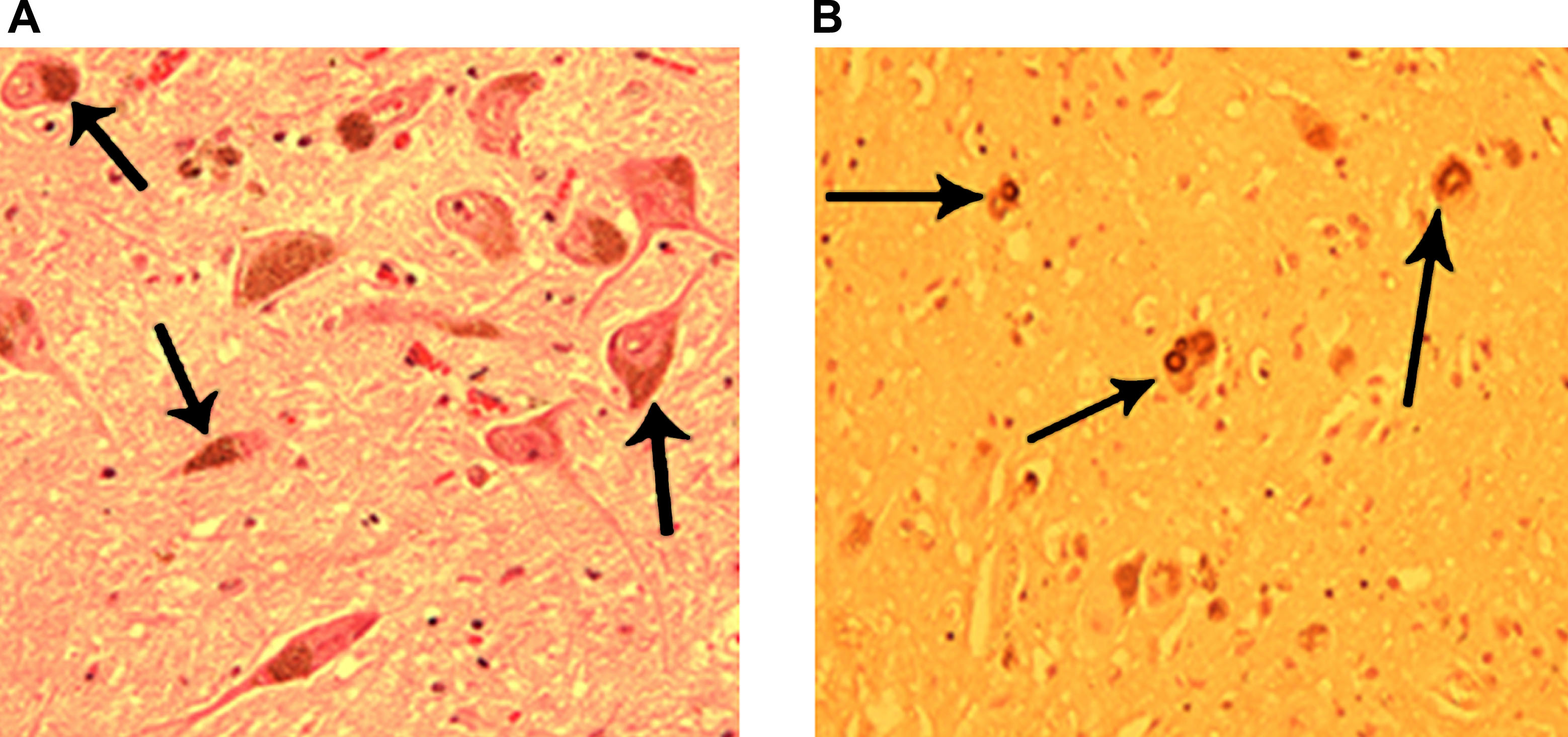 圖3：正常和帕金森病患者的黑質(zhì)。