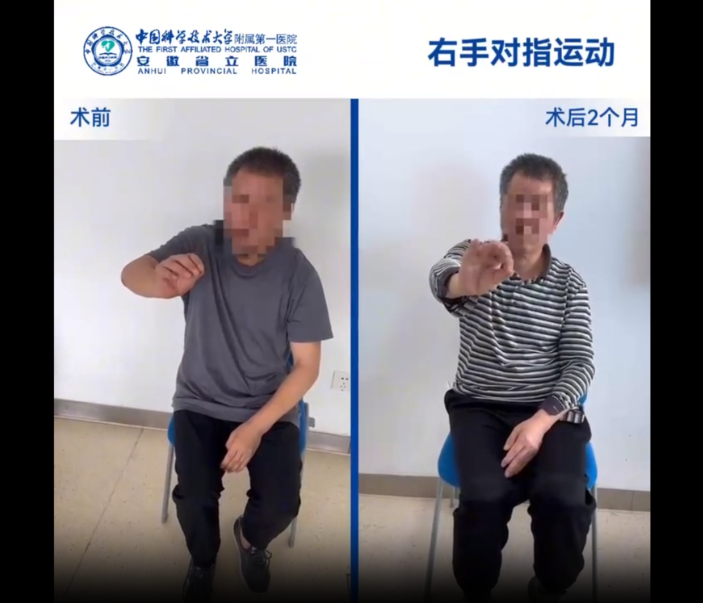 國內誘導多能干細胞療法新突破：首例早發型帕金森病成功給藥，當天即可行走