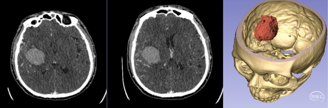 神經(jīng)外科手術(shù)機器人輔助下腦內(nèi)血腫穿刺術(shù)