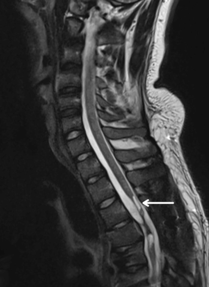 圖2:X射線圖像顯示慢性期脊髓損傷,通常以囊腫形成為特征,如白色箭頭所示 圖2:X射線圖像顯示慢性期脊髓損傷,通常以囊腫形成為特征,如白色箭頭所示