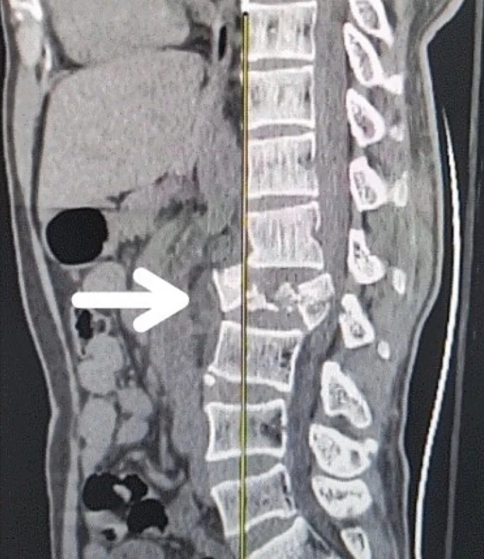 圖1:X射線圖像顯示脊髓損傷,椎骨骨折和移位,如白色箭頭所示 圖1:X射線圖像顯示脊髓損傷,椎骨骨折和移位,如白色箭頭所示