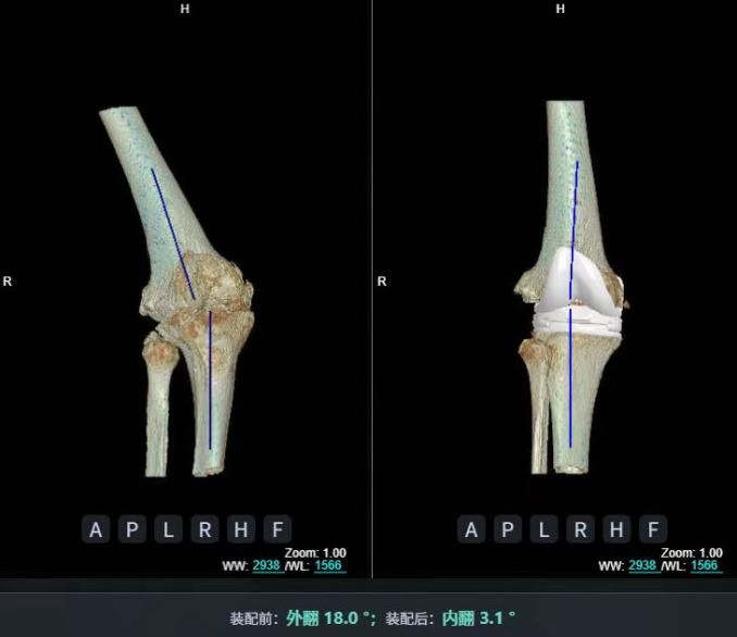 AI精準(zhǔn)關(guān)節(jié)置換 AI精準(zhǔn)關(guān)節(jié)置換