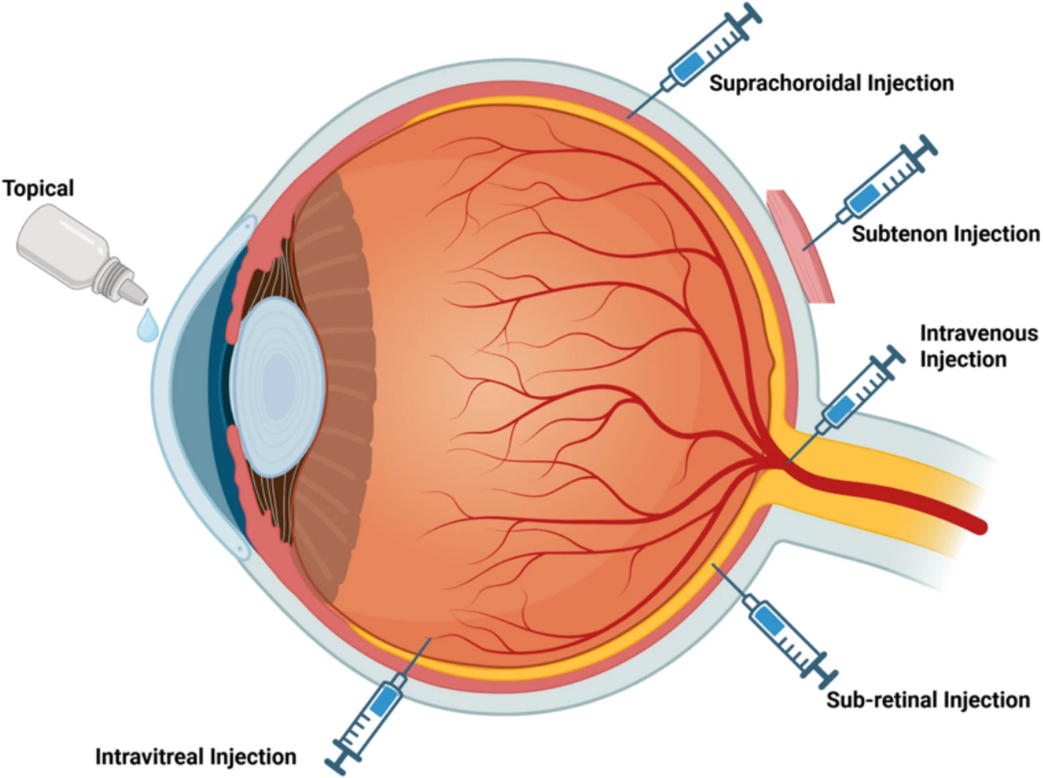 圖2：眼部基因和干細胞治療的給藥途徑