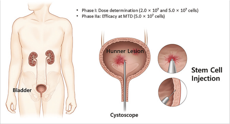 間質(zhì)性膀胱炎臨床試驗(yàn)