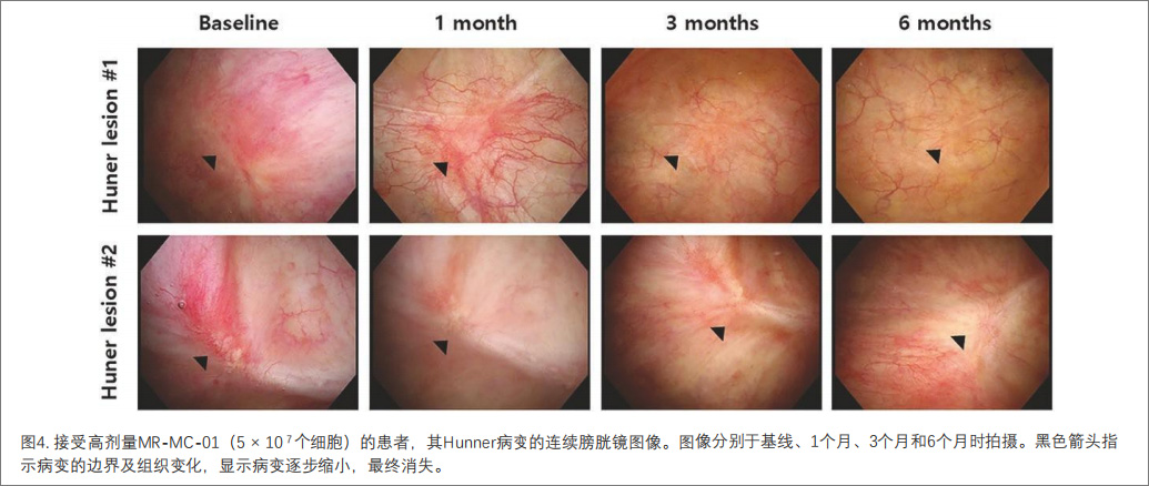 間質性膀胱炎臨床試驗