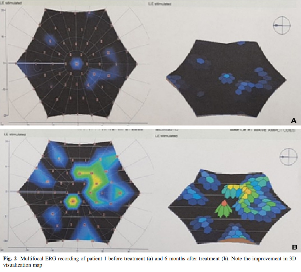 視神經萎縮臨床試驗