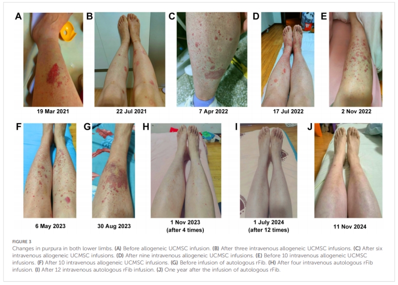 干燥綜合征臨床試驗(yàn)