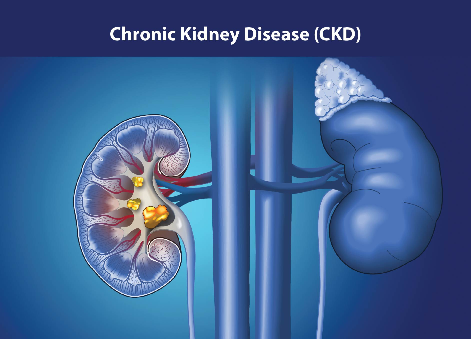 慢性腎病治療新策略:間充質干細胞如何修復腎功能、延緩疾病進展? 慢性腎病治療新策略:間充質干細胞如何修復腎功能、延緩疾病進展?