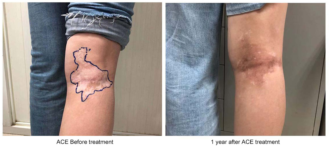 干細胞移植前后白癜風癥狀改變 干細胞移植前后白癜風癥狀改變
