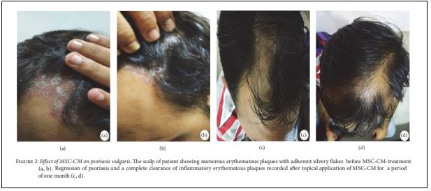 圖2：MSC-CM對(duì)尋常型銀屑病的影響。