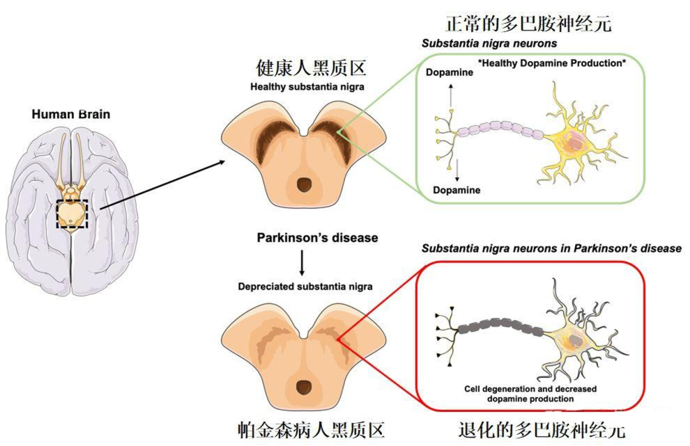 帕金森病患者的腦部黑質(zhì)區(qū)