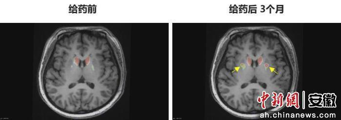 圖為李女士 PET-DAT/MRI融合圖像術前與術后三個月對比。 圖為李女士 PET-DAT/MRI融合圖像術前與術后三個月對比。