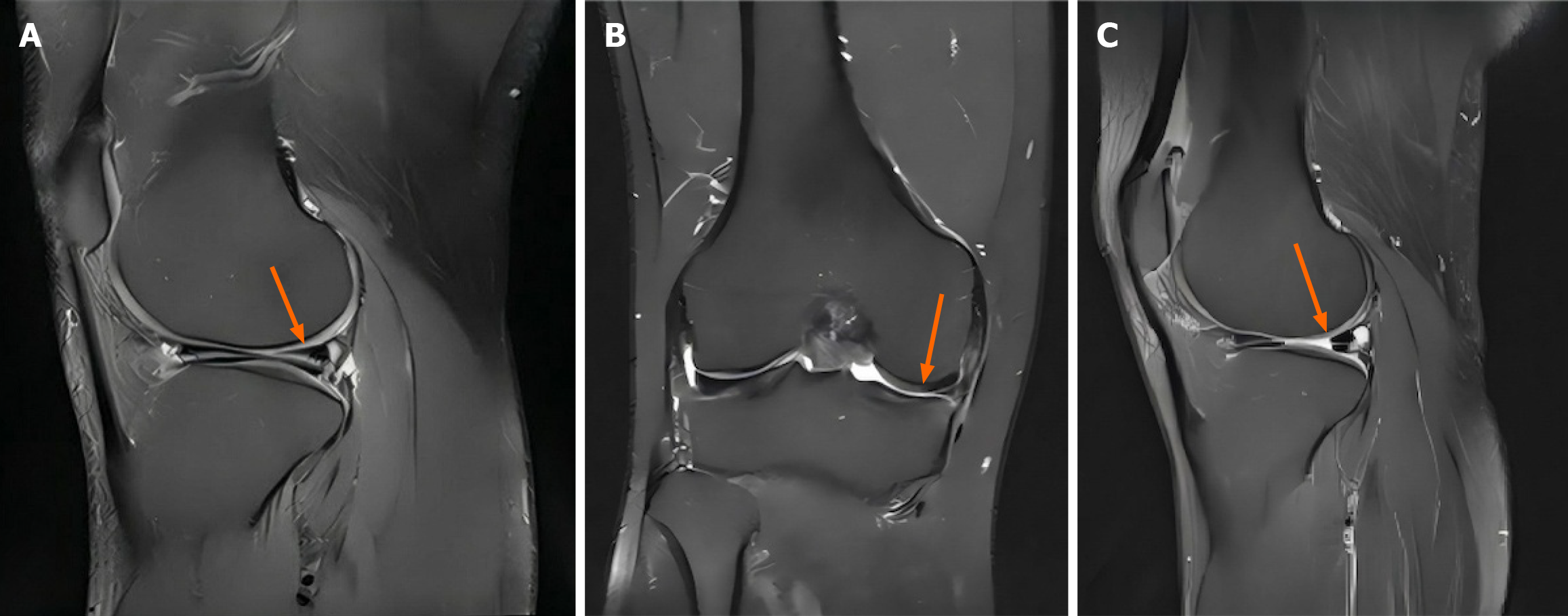 圖2:間充質干細胞治療后半月板組織的代表性磁共振成像圖像。 圖2:間充質干細胞治療后半月板組織的代表性磁共振成像圖像。